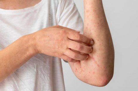 Alergia à água: 7 mitos e verdades sobre esse problema